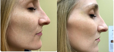 Laser Genesis before and after photo
