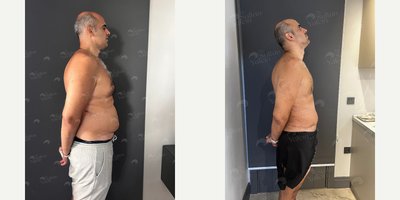 Liposuction before and after photo