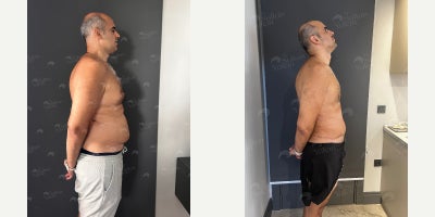 Liposuction before and after photo