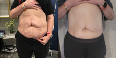 Microneedling RF before and after photo