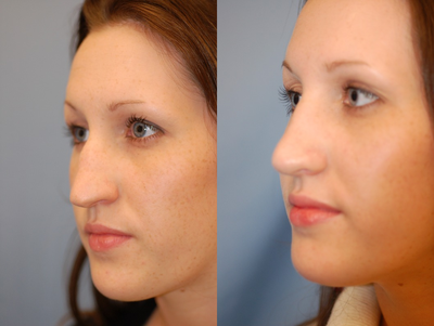 Rhinoplasty before and after photo