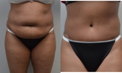 Tummy Tuck before and after photo