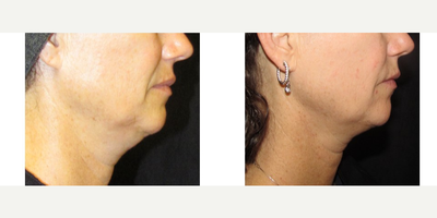 Ultherapy before and after photo