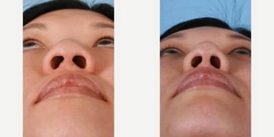 Asian Rhinoplasty before and after photo