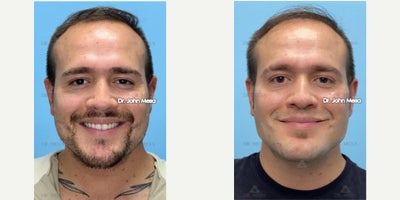 Chin Filler before and after photo