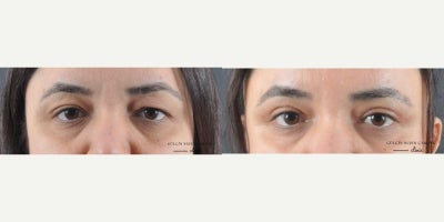 Eyelid Surgery before and after photo