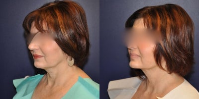 Liposuction before and after photo
