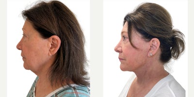 Neck Lift before and after photo