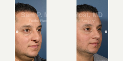Revision Rhinoplasty before and after photo