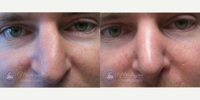 Rhinoplasty before and after photo