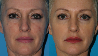 Skin Rejuvenation before and after photo