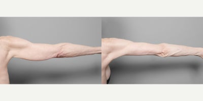 Arm Lift before and after photo