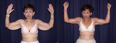 Arm Lift before and after photo