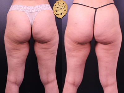 Cellfina before and after photo