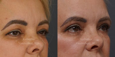 Double Eyelid Surgery before and after photo