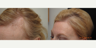 NeoGraft before and after photo