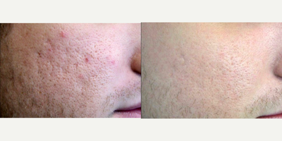 ProFractional Laser before and after photo