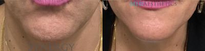 Botox before and after photo