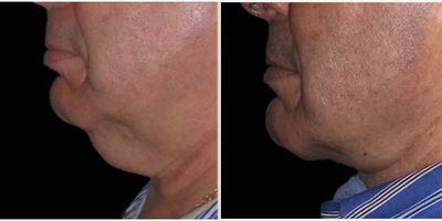 Facelift before and after photo