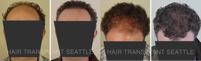 Hair Transplant before and after photo