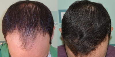Hair Transplant before and after photo