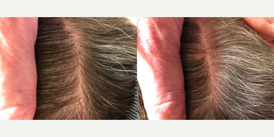Hair Transplant before and after photo