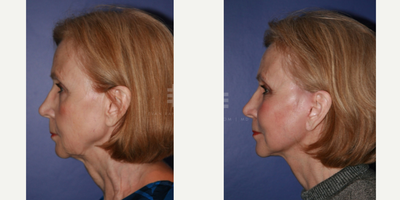 Neck Lift before and after photo