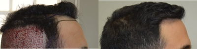 PRP for Hair Loss before and after photo
