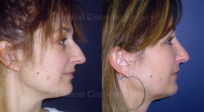 Rhinoplasty before and after photo
