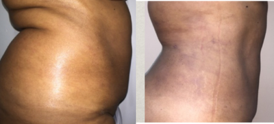 Vaser Liposuction before and after photo