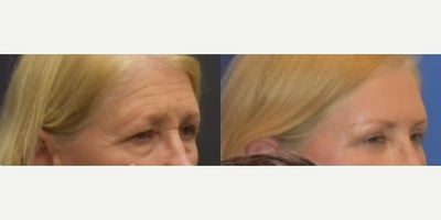 Eyelid Surgery before and after photo