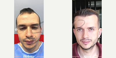 Hair Transplant before and after photo