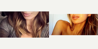Lip Fillers before and after photo