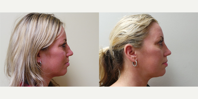 Rhinoplasty before and after photo