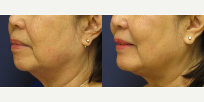 Chin Implant before and after photo