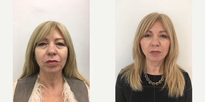 Nonsurgical Facelift before and after photo