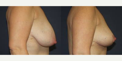 Breast Reduction before and after photo