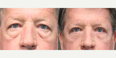 Eyelid Surgery before and after photo