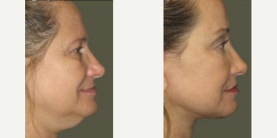 Facelift before and after photo