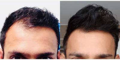 FUE Hair Transplant before and after photo
