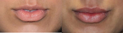 Juvederm before and after photo