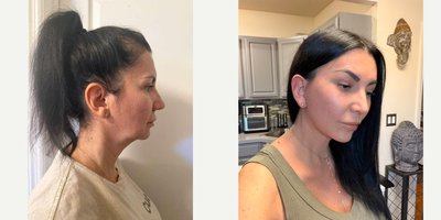 Neck Lift before and after photo