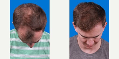 NeoGraft before and after photo