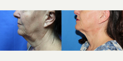 PrecisionTx before and after photo