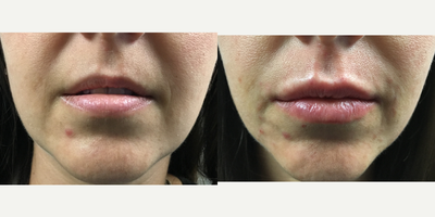 Restylane Silk before and after photo