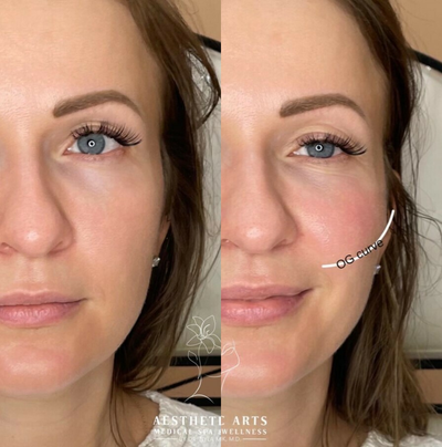 Voluma before and after photo
