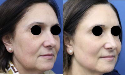 Belotero before and after photo