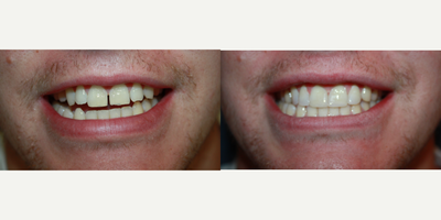 Dental Bonding before and after photo