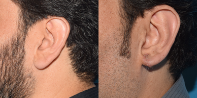 Earlobe Repair before and after photo