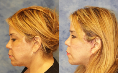 Facelift before and after photo